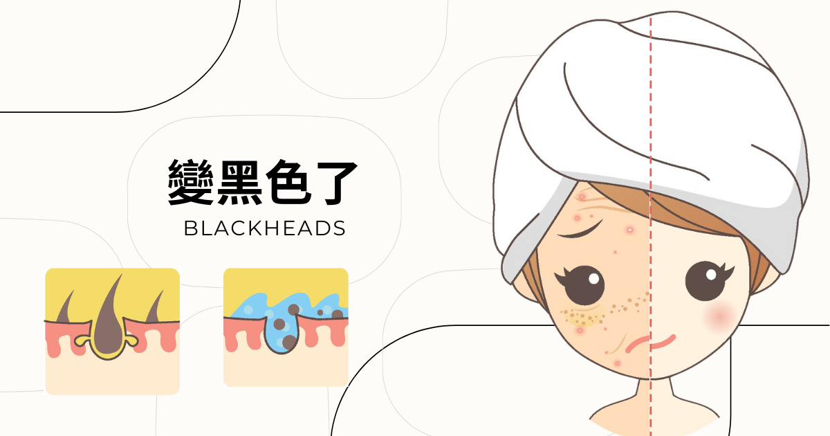 清粉刺教學圖示，展示實際操作流程與手法，強調無創溫和方式