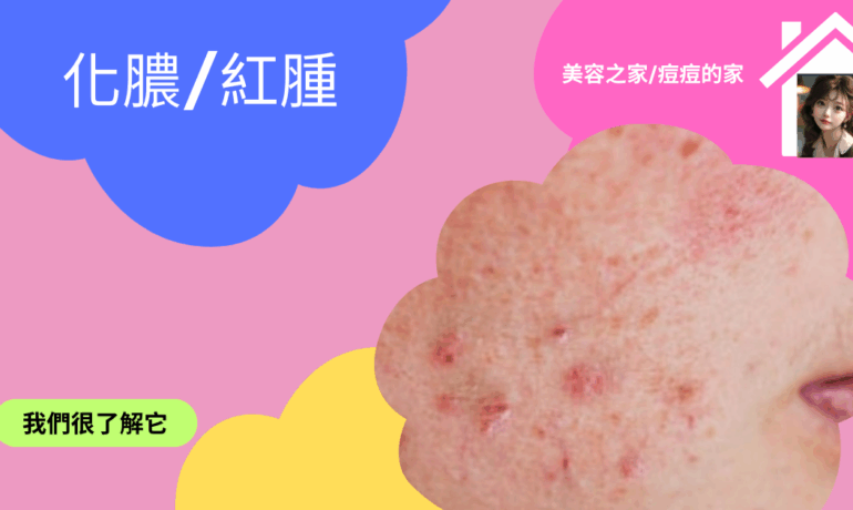 紅腫acne擦甚麼