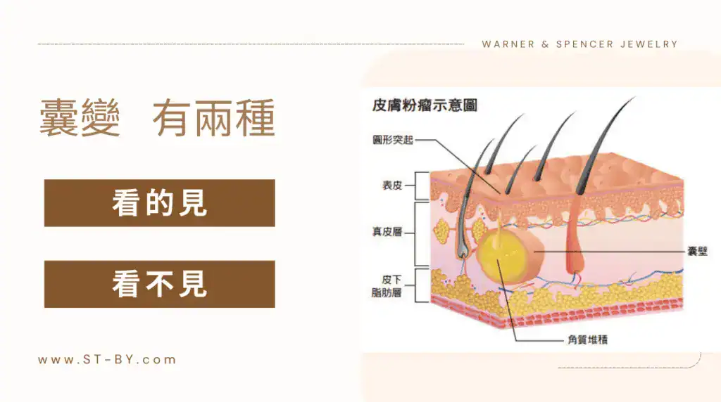 pidermoid cyst visible vs invisible Cross-sectional diagram of an epidermoid cyst, illustrating the difference between visible and invisible skin lumps.
