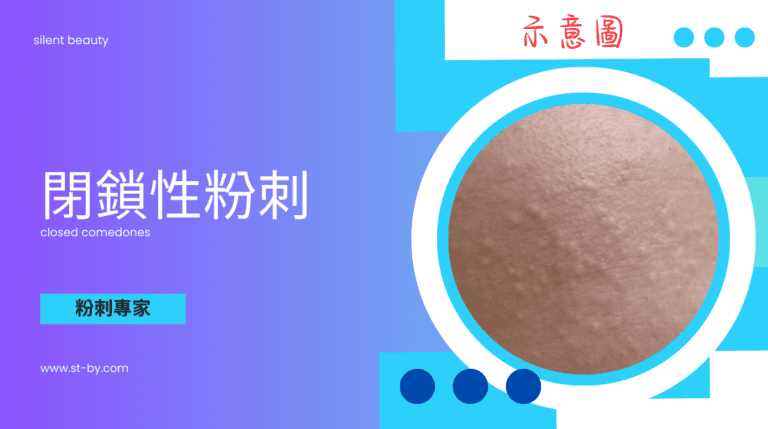 內包型粉刺除粉刺專家