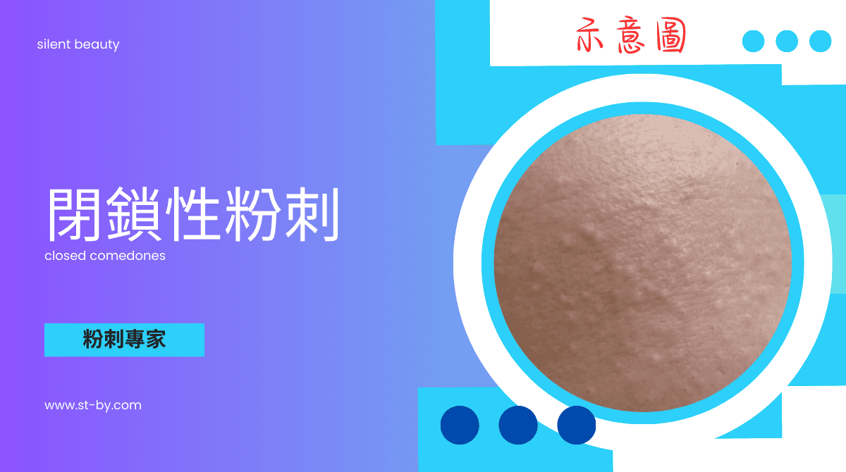 內包型粉刺除粉刺專家