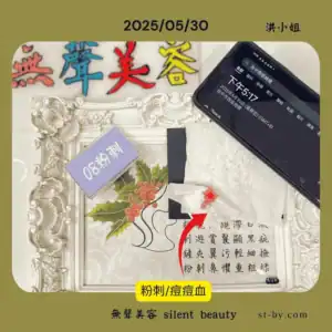 2025年5月30日下午5點17分清理粉刺紀錄，衛生紙上留有血點，屬真實操作痕跡，為無聲美容粉刺牆日常照片之一。