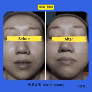 acne blackhead skin cleansing 17