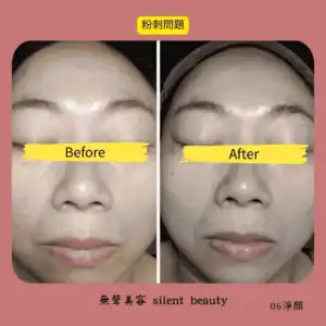 acne cleansing face true record