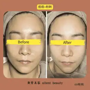 acne comedone dual treatment