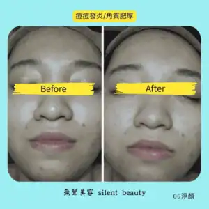 acne inflammation keratin thickening 06