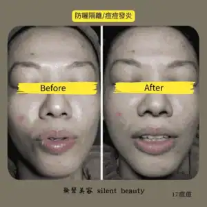 acne inflammation quarantine effect 17