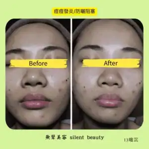 acne inflammation sunscreen clogging 13