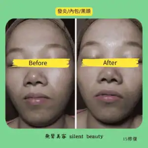 acne inner acne blackheads clearing