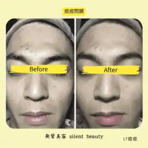 acne problem improve real proof