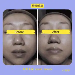 acne pustules redness calming
