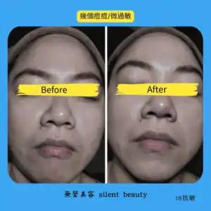 anti acne sensitive skin before after