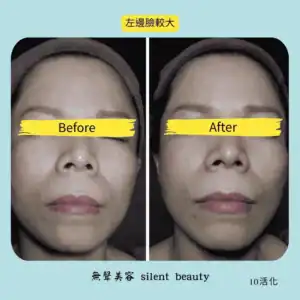 asymmetrical face left side reduction 10