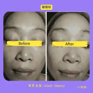 brow line smooth visible compare