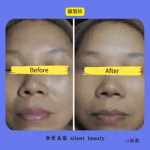 brow line wrinkle softening