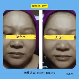 brow wrinkle oily skin balance