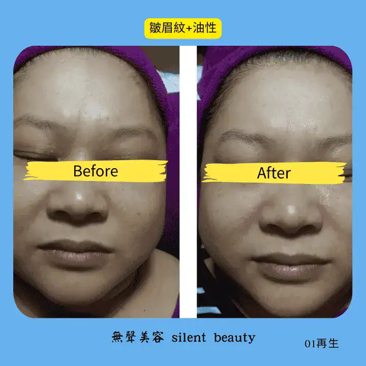 brow wrinkle oily skin balance