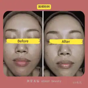 cheek comedo clear pore compare