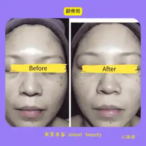 cheek spot fade skin evening
