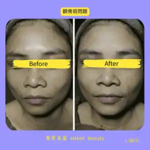 cheekbone spots treatment before after