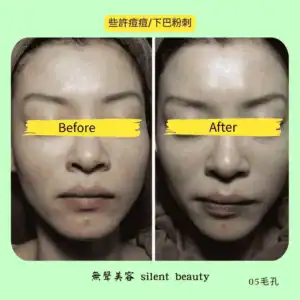 chin acne blackhead removal