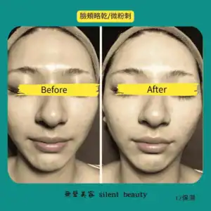 dry cheeks micro acne soothing