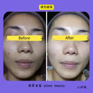 dull yellow skin tone clearing 02