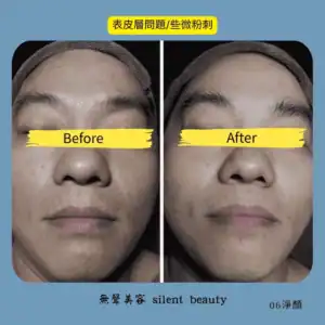 epidermal clogged pores fine comedones