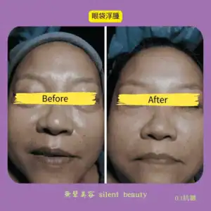 eye bag swelling fade visible effect