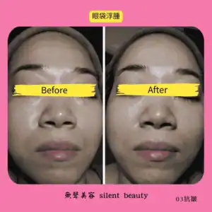 eye bag swelling visible reduction 03