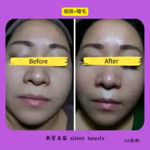 facial blackhead care visible improvement 08