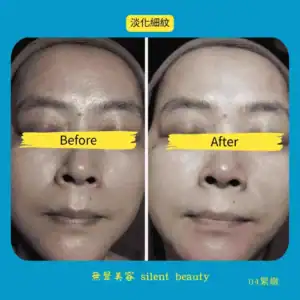 fine line soften visible difference