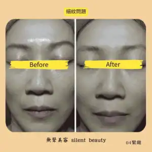 fine lines treatment effect 04