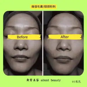 forehead comedones pores cleaning