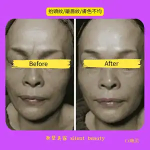 forehead frown lines uneven tone correction