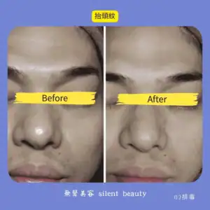 forehead line reduction visible