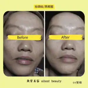 forehead lines dark circles lifting effect 04