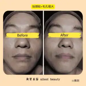 forehead lines pore size reduced 11