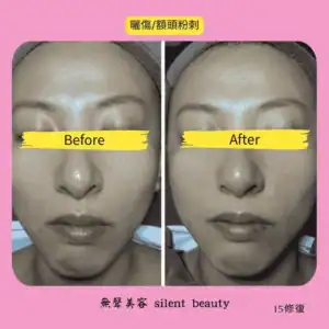 forehead scars and comedones 15