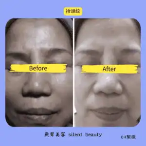 forehead wrinkles reduced tighten effect