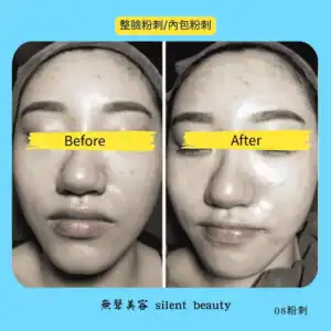 full face acne extraction before after