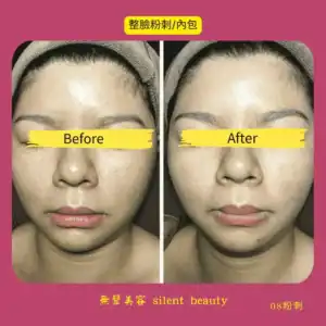 full face acne inner clog treatment