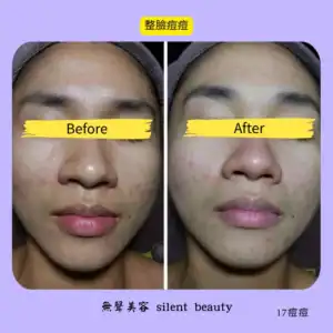 full face acne treatment result 17