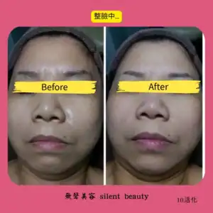 full face rejuvenation in progress 10