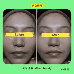inner acne reduced clear compare