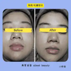 keratin folliculitis skin repair 15