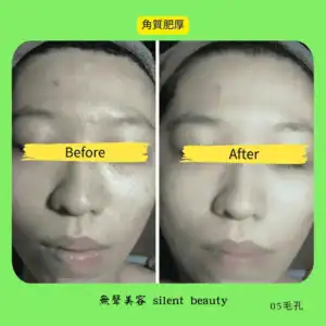 keratin thick pores before after