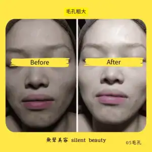 large pores before after clear skin 05