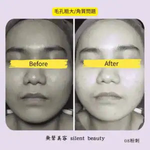 large pores keratin treatment