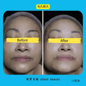 large pores shrink visible effect